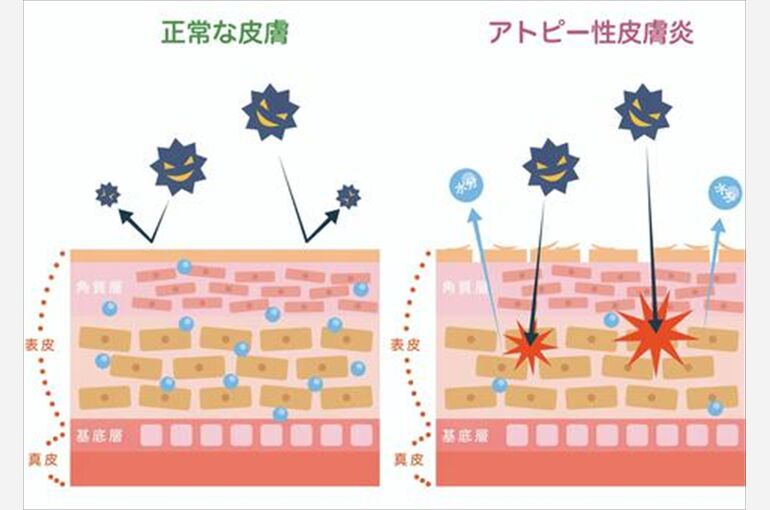 アトピー